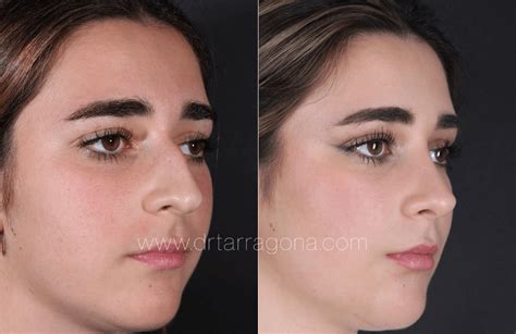 Rinoplastia Estructural Antes Y Después Dr Tarragona