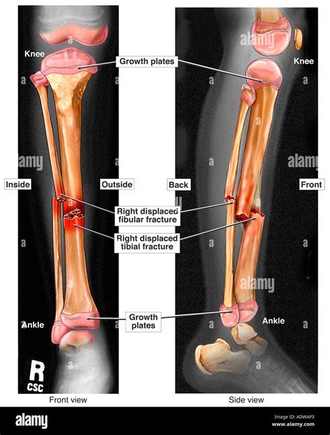 Right Tibia Fracture