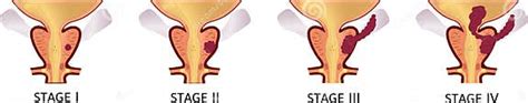 Stages Of Prostate Cancer From I To Iv The Tumor Grows And Penetrates