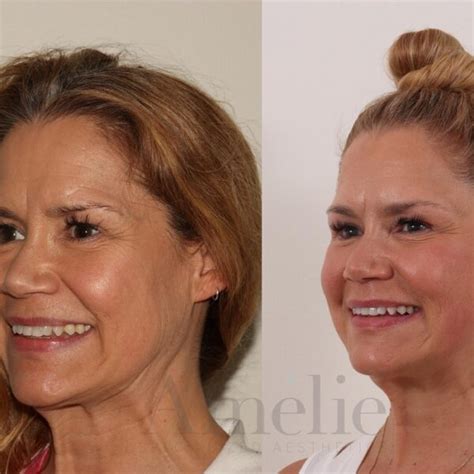 Sculptra Before And After Transforming Your Appearance With Long Lasting Results Must Read