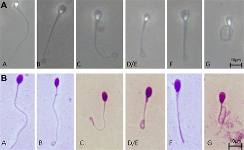 Hypo Osmotic Swelling Test Identifies Individual Spermatozoa With