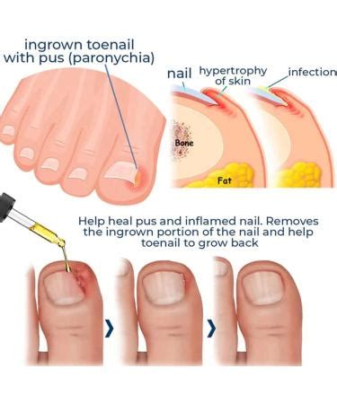 German Toenailcare Removal Paronychia Oil German Bunion Therapy Oil