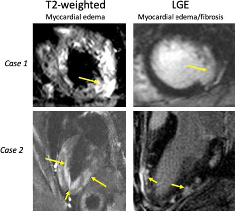 Recognition And Initial Management Of Fulminant Myocarditis Circulation