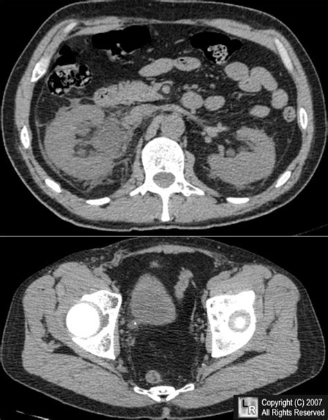 Learning Radiology Ureteral Calculus Stone Kidney Ureter