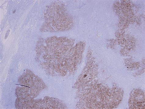 Pathology Outlines Cd21