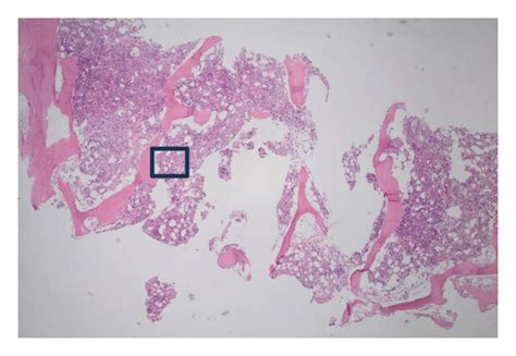 Bone Marrow Histology In Hyperhemolysis Syndrome Hematoxylin And Eosin