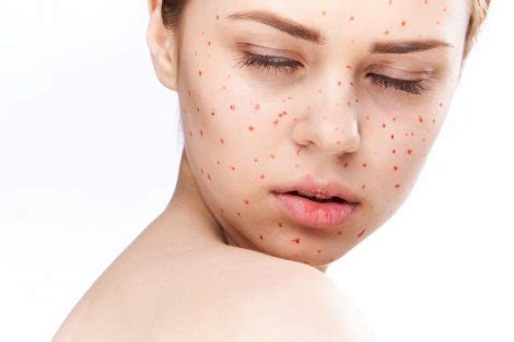 Causes of Small Red Dots on Skin and Treatment - Charlies Magazines