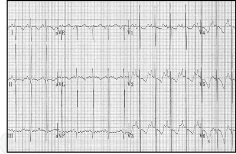 Right Ventricular Hypertrophy Criteria