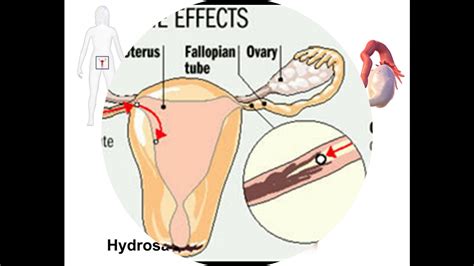 Hydrosalpinx Youtube