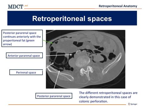 Retroperitoneal Anatomy