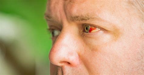 Sangue Nos Olhos Entenda A Hemorragia Subconjuntival Neo Oftalmo