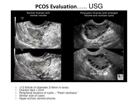 Pcos