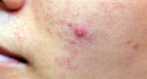 Acne Papules: Causes, Treatments, Natural Remedies, Do's and Don’ts