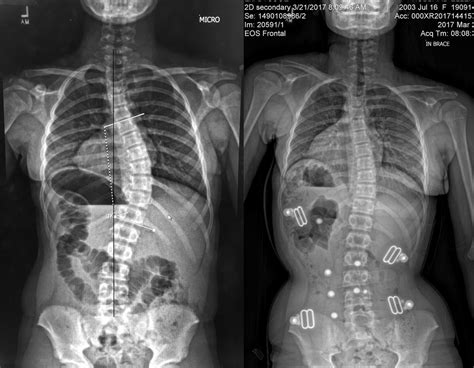 Scoliosis Brace Wear Time - LA Brace Center