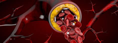 Hypercholesterolemia Vs Hyperlipidemia