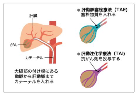 肝臓がんとは 北青山dクリニック