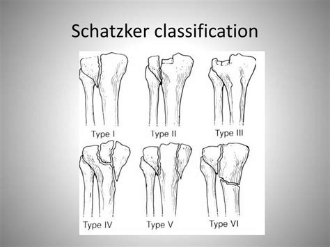 Ppt Approach To The Knee Radiograph For Bony Injuries Powerpoint