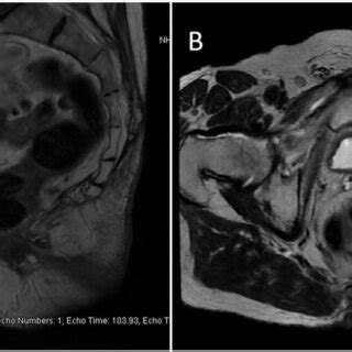 Pelvic Magnetic Resonance Imaging A Sagittal B Axial T Weightted