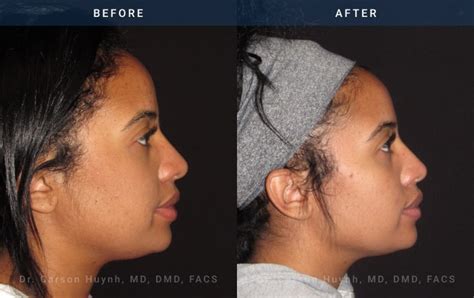 Rhinoplasty Case 1882 Radiance Surgery Aesthetic Medicine