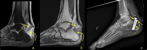 MRI Of The Achilles Tendon A Comprehensive Pictorial Review Part Two