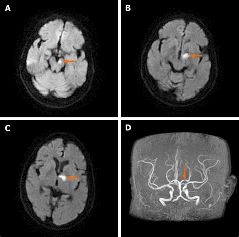 Hemichorea Due To Ipsilateral Thalamic Infarction A Case Report