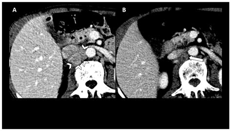 Combination Of Pembrolizumab And Stereotactic Body Radiation Therapy In