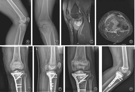 An Illustrative Case Of Giant Cell Tumor Of The Bone GCTB With