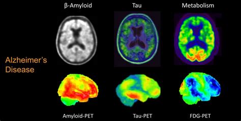 The Nuclear Medicine Approach To Alzheimers Healthcare In Europe