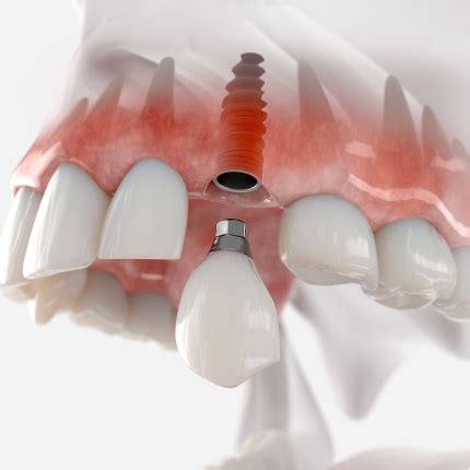 Dental Implants In Coral Gables Fl Implant Dentist