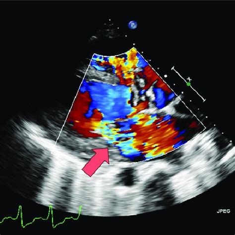 Transesophageal Echocardiogram Showing Severe Pulmonic Valve