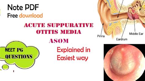 Acute Suppurative Otitis Media Asom Ent Easy Explanation Stages Diagnosis Management