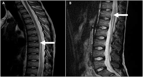 Longitudinally Extensive Transverse Myelitis A Catastrophic Presentation Of A Flare Up Of