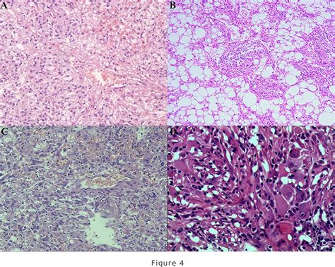 PDF New Recognition Of Hepatic Perivascular Epithelioid Cell Tumours