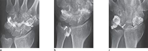 Mr Arthrography Of The Wrist Scanning Room Injection Of 48 Off