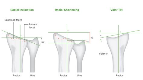 Distal Radius Fractures | Concise Medical Knowledge