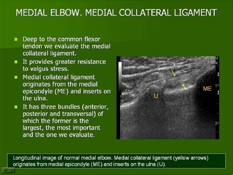 Ultrasound Of The Elbow What The Radiologist Should Know Semantic