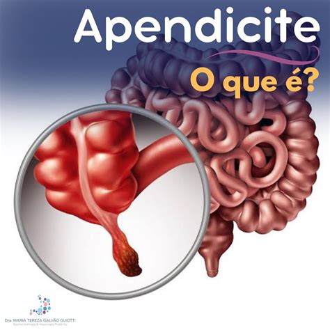 Apendicite O Que Dra Maria Tereza Pediatra Gastroenterologia E