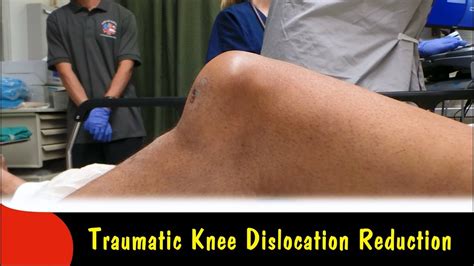 Traumatic Knee Dislocation Reduction-Quick Version - YouTube