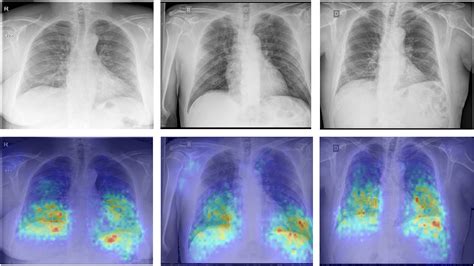 A Review On Lung Boundary Detection In Chest X Rays International