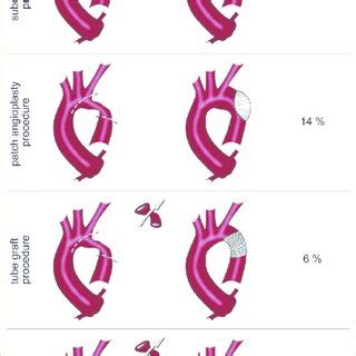 Anatomical Types Of Bicuspid Aortic Valve BAV According To A Classifi