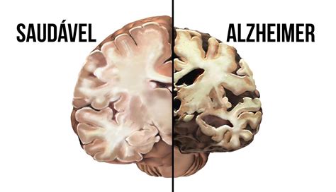 Mês de Conscientização à Doença de Alzheimer O que você pode fazer