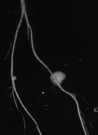 D Reconstruction Of Ct Angiogram Shows The Right And Left Common