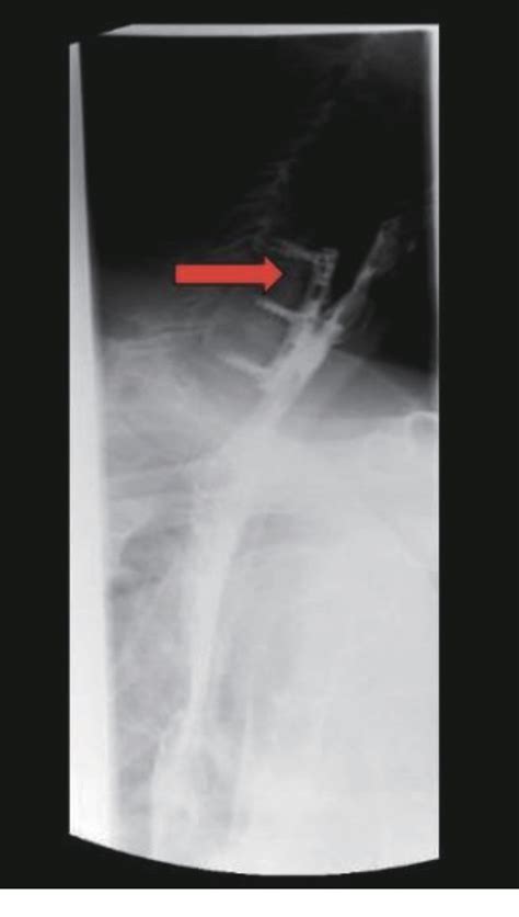 Figure From Esophageal Perforation In A Year Old Man After C C