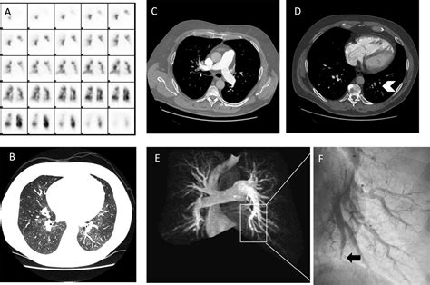 Chronic Thromboembolic Pulmonary Hypertension Interventional