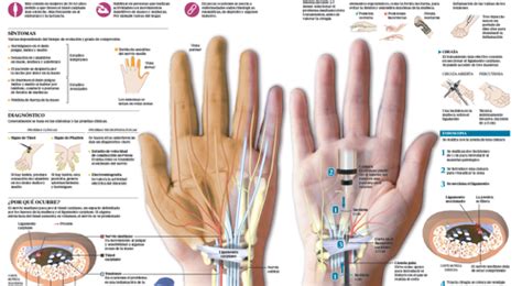 Cirug A Del T Nel Carpiano Tratamiento Cl Nica Universidad De Navarra