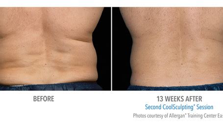 CoolSculpting Flanks Before and Afters | Spa Greystone