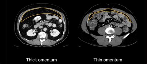 Abdominal Ct Peritoneal Cavity • Litfl • Radiology Library