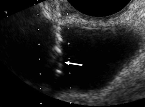 Sonographically Guided Transvaginal Or Transrectal Pelvic Abscess