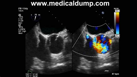 Bicuspid Aortic Valve - Severe Aortic Regurgitation - TransEsophageal ...