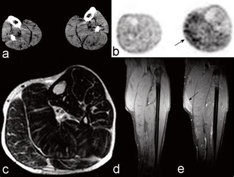 Figure 1 From Unilateral Muscle Hypertrophy And Focal Myositis